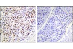 Immunohistochemistry analysis of paraffin-embedded human liver carcinoma, using AurB (Phospho-Thr232) Antibody. (Aurora Kinase B 抗体  (pThr232))