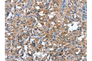 The image on the left is immunohistochemistry of paraffin-embedded Human thyroid cancer tissue using ABIN7191907(PLA2G6 Antibody) at dilution 1/15, on the right is treated with synthetic peptide. (PLA2G6 抗体)