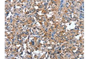 The image on the left is immunohistochemistry of paraffin-embedded Human thyroid cancer tissue using ABIN7191907(PLA2G6 Antibody) at dilution 1/15, on the right is treated with synthetic peptide. (PLA2G6 抗体)