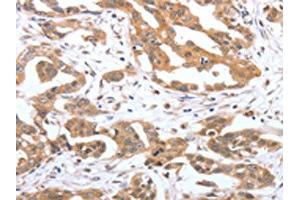 The image on the left is immunohistochemistry of paraffin-embedded Human ovarian cancer tissue using ABIN7192042(PSPN Antibody) at dilution 1/25, on the right is treated with synthetic peptide. (Persephin 抗体)
