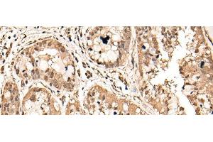 Immunohistochemistry of paraffin-embedded Human liver cancer tissue using ATAD3A Polyclonal Antibody at dilution of 1:40(x200) (ATAD3A 抗体)