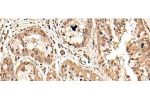 Immunohistochemistry of paraffin-embedded Human liver cancer tissue using ATAD3A Polyclonal Antibody at dilution of 1:40(x200)