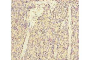 Immunohistochemistry of paraffin-embedded human ovarian cancer using ABIN7170910 at dilution of 1:100 (SUCLA2 抗体  (AA 1-180))
