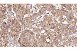 ABIN6276463 at 1/100 staining Human Melanoma tissue by IHC-P. (Endothelin 3 抗体  (C-Term))