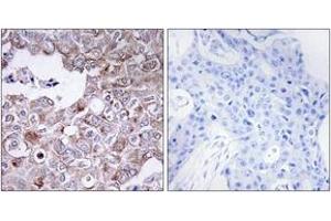 Immunohistochemistry analysis of paraffin-embedded human breast carcinoma tissue, using MUC1 Antibody. (MUC1 抗体  (AA 1191-1240))