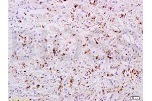 Immunohistochemistry (Paraffin-embedded Sections) (IHC (p)) image for anti-Signal Transducer and Activator of Transcription 6, Interleukin-4 Induced (STAT6) (pTyr641) antibody (ABIN734483)
