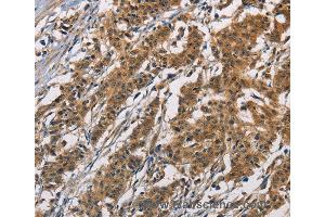 Immunohistochemistry of Human colon cancer using ATP2C1 Polyclonal Antibody at dilution of 1:60 (ATP2C1 抗体)