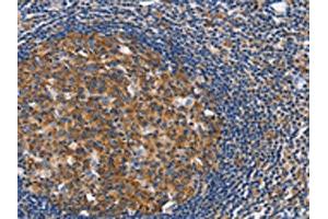 The image on the left is immunohistochemistry of paraffin-embedded Human tonsil tissue using ABIN7128916(CEP97 Antibody) at dilution 1/40, on the right is treated with fusion protein. (CEP97 抗体)
