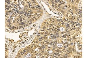 HSP70 Mouse Monoclonal Antibody at 1/100 staining human lung cancer and adjacent non-tumor tissue by IHC-P. (HSP70 抗体  (C-Term))