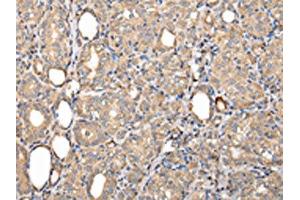 The image on the left is immunohistochemistry of paraffin-embedded Human thyroid cancer tissue using ABIN7128011(SERPINA7 Antibody) at dilution 1/25, on the right is treated with fusion protein. (SERPINA7 抗体)