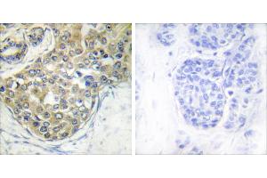 Immunohistochemistry analysis of paraffin-embedded human breast carcinoma tissue using ACK1 (Phospho-Tyr284) antibody. (TNK2 抗体  (pTyr284))
