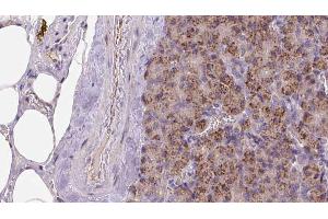 ABIN6273259 at 1/100 staining Human pancreas cancer tissue by IHC-P. (KIDINS220 抗体  (Internal Region))