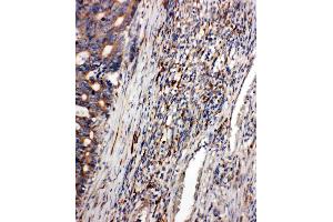 Anti-CD163 antibody, IHC(P): Human Intestinal Cancer Tissue (CD163 抗体  (AA 1056-1165))