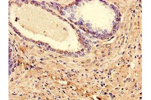 Immunohistochemistry of paraffin-embedded human prostate cancer using ABIN7158308 at dilution of 1:100 (Leupaxin 抗体  (AA 1-300))