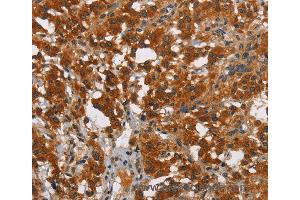 Immunohistochemistry of Human thyroid cancer using SMAD9 Polyclonal Antibody at dilution of 1:40 (SMAD9 抗体)