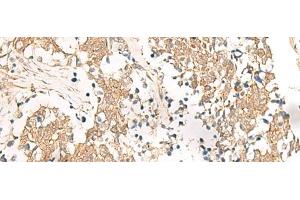 Immunohistochemistry of paraffin-embedded Human lung cancer tissue using HNF1A Polyclonal Antibody at dilution of 1:25(x200) (HNF1A 抗体)