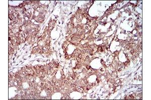 Immunohistochemical analysis of paraffin-embedded cervical cancer tissues using MMEL1 mouse mAb with DAB staining. (MMEL1 抗体  (AA 1-107))