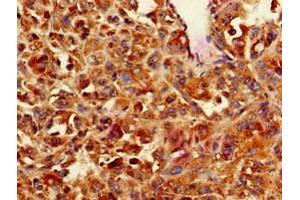Immunohistochemistry of paraffin-embedded human melanoma using ABIN7146559 at dilution of 1:100 (CNN3 抗体  (AA 2-329))