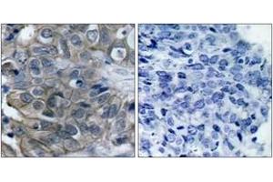 Immunohistochemistry analysis of paraffin-embedded human breast carcinoma tissue, using HER2 (Ab-877) Antibody. (ErbB2/Her2 抗体  (AA 851-900))