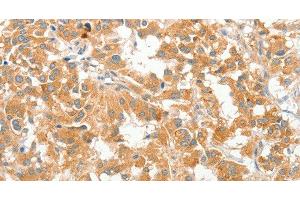 Immunohistochemistry of paraffin-embedded Human thyroid cancer using COL4A3BP Polyclonal Antibody at dilution of 1:60 (COL4A3BP 抗体)