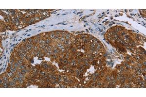 Immunohistochemistry of paraffin-embedded Human ovarian cancer using SNCG Polyclonal Antibody at dilution of 1:60 (SNCG 抗体)