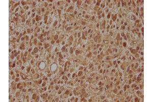 IHC image of ABIN7143497 diluted at 1:100 and staining in paraffin-embedded human glioma cancer performed on a Leica BondTM system. (ARL2BP 抗体  (AA 1-163))