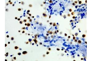 ICC staining of formalin fixed and paraffin embedded human WiDr cells (400X, Positive) with recombinant BRAF V600E antibody.