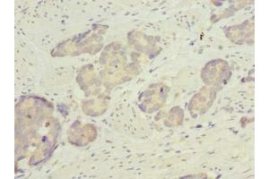 Immunohistochemistry of paraffin-embedded human gastric cancer using ABIN7158529 at dilution of 1:100 (ACSBG2 抗体  (AA 301-600))