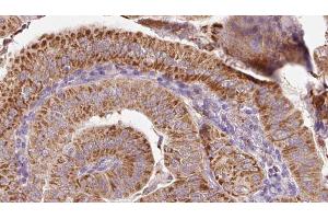 ABIN6267087 at 1/100 staining Human thyroid cancer tissue by IHC-P. (PKD2 抗体  (pSer812))