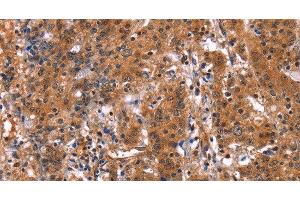 Immunohistochemistry of paraffin-embedded Human gastric cancer using GUK1 Polyclonal Antibody at dilution of 1:50 (GUK1 抗体)