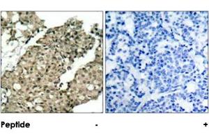 Imunohistochemical analysis of paraffin-embedded human breast carcinoma tissue, using G3BP1 (phospho S232) polyclonal antibody  (A) or preincubated with blocking peptide (B).