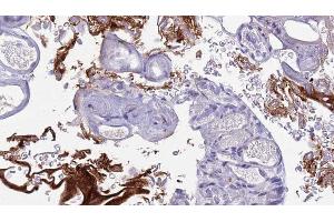 ABIN6273442 at 1/100 staining Human urothelial cancer tissue by IHC-P. (CD177 抗体  (Internal Region))