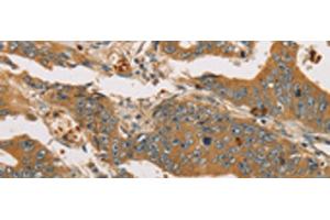Immunohistochemistry of paraffin-embedded Human gastric cancer tissue using XPR1 Polyclonal Antibody at dilution of 1:45(x200) (xpr1 抗体)
