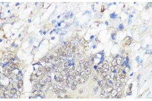 Immunohistochemistry of paraffin-embedded Human colon carcinoma using GPX2 Polyclonal Antibody at dilution of 1:100 (40x lens). (Glutathione Peroxidase 2 抗体)