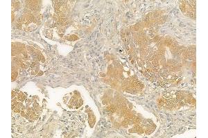 ABIN6263074 and ABIN6278147 at 1/100 staining human lung squamous cell carcinoma by IHC-P. (Melanoma Antigen Family D, 4 (MAGED4) (N-Term) 抗体)