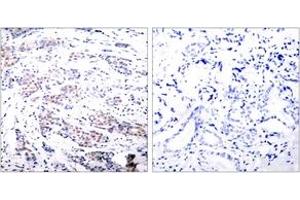 Immunohistochemistry analysis of paraffin-embedded human breast carcinoma tissue, using Elk1 (Ab-383) Antibody. (ELK1 抗体  (AA 351-400))