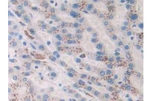 Detection of Ang1-7 in Human Liver cancer Tissue using Monoclonal Antibody to Angiotensin 1-7 (Ang1-7) (Angiotensin 1-7 抗体)