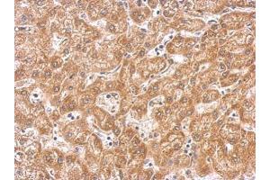 IHC-P Image PAK1 antibody detects PAK1 protein on human hepatoma by immunohistochemical analysis. (PAK1 抗体  (Center))