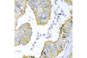 Immunohistochemistry of paraffin-embedded human colon carcinoma using KRBOX4 antibody at dilution of 1:200 (40x lens).