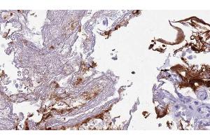 ABIN6273445 at 1/100 staining Human urothelial cancer tissue by IHC-P. (CD27 抗体  (Internal Region))