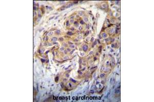DUSP3 Antibody immunohistochemistry analysis in formalin fixed and paraffin embedded human breast carcinoma followed by peroxidase conjugation of the secondary antibody and DAB staining. (Dual Specificity Phosphatase 3 (DUSP3) (AA 157-185), (C-Term) 抗体)