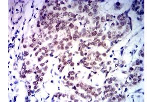 Immunohistochemical analysis of paraffin-embedded bladder cancer tissues using MLH1 mouse mAb with DAB staining. (MLH1 抗体  (AA 381-483))