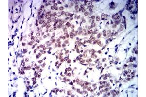 Immunohistochemical analysis of paraffin-embedded bladder cancer tissues using MLH1 mouse mAb with DAB staining. (MLH1 抗体  (AA 381-483))