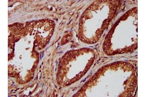 IHC image of ABIN7155827 diluted at 1:300 and staining in paraffin-embedded human prostate cancer performed on a Leica BondTM system. (NKX2-8 抗体  (AA 1-160))