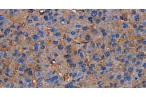 Immunohistochemistry of paraffin-embedded Human liver cancer tissue using NRIP3 Polyclonal Antibody at dilution 1:60 (NRIP3 抗体)