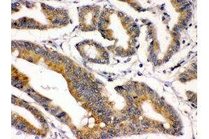 IHC(P): Human Intestinal Cancer Tissue (BMP2 抗体  (C-Term))