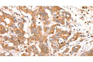 Immunohistochemistry of paraffin-embedded Human colon cancer tissue using CELSR2 Polyclonal Antibody at dilution 1:50