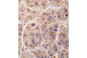 Formalin-fixed and paraffin-embedded human hepatocarcinoma tissue reacted with PIM3 antibody , which was peroxidase-conjugated to the secondary antibody, followed by DAB staining. (PIM3 抗体  (C-Term))