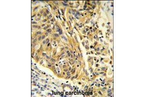 Formalin-fixed and paraffin-embedded human lung carcinoma reacted with CLTA Antibody , which was peroxidase-conjugated to the secondary antibody, followed by DAB staining. (CLTA 抗体  (AA 99-127))