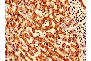 Immunohistochemistry analysis of human liver cancer using ABIN7171128 at dilution of 1:100 (SYNJ2BP 抗体  (AA 1-117))